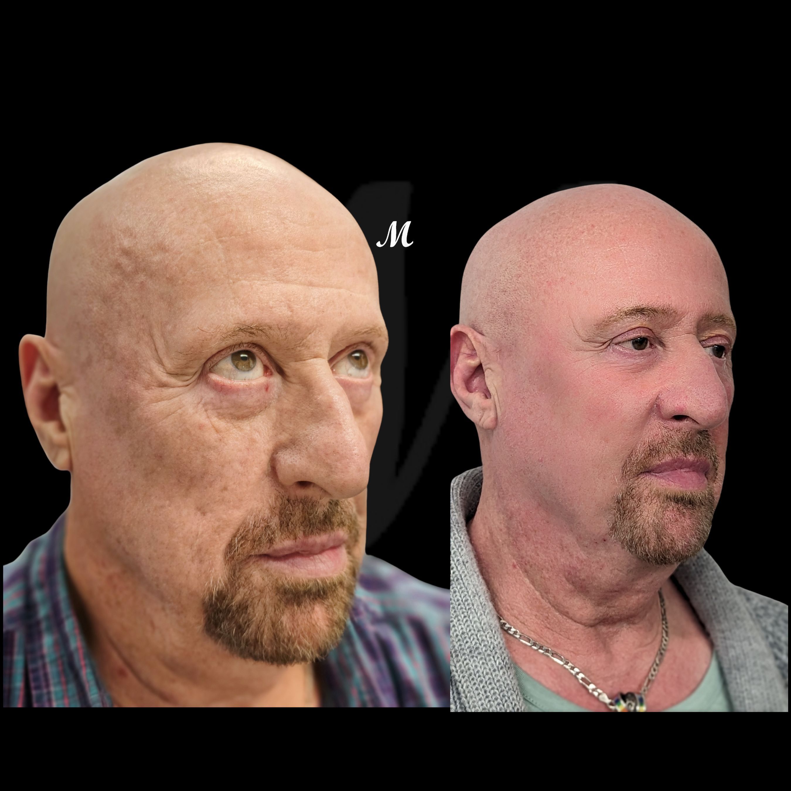 Face Lift